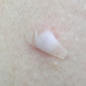 hydrocolloid dressing